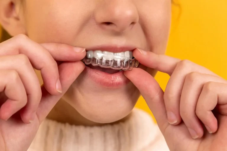 Invisalign for Teeth Alignment