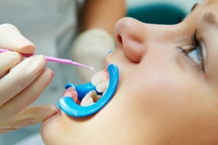 Sealants For Children’s Teeth