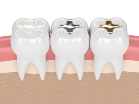 Different Types Of Dental Fillings